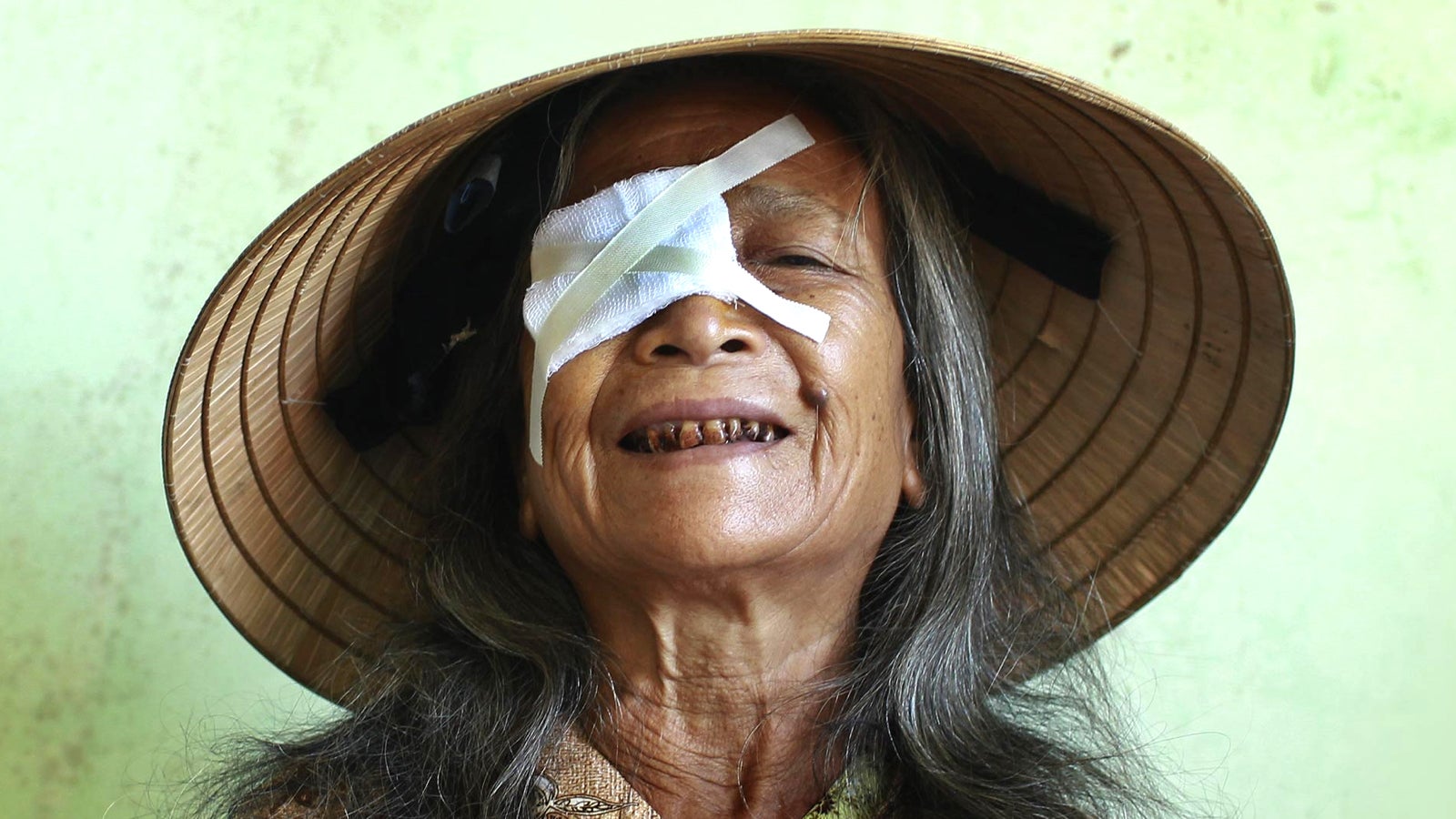 Elderly woman with dressing over her right eye